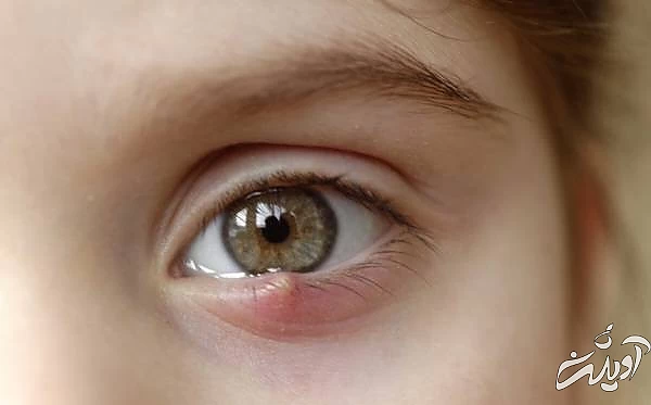 ترشح زرد رنگ چشم گل مژه